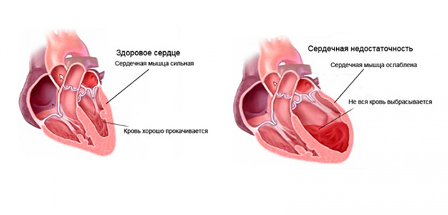 Отеки ног при сердечной недостаточности