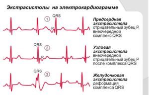 Экстрасистолы при ВСД: симптомы, методы лечения