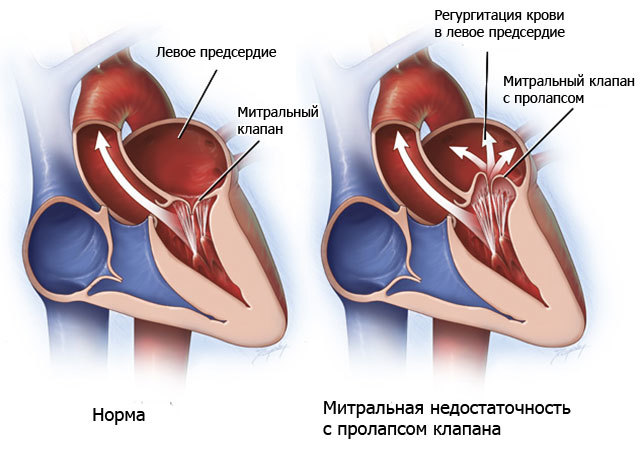 Приобретенный порок сердца