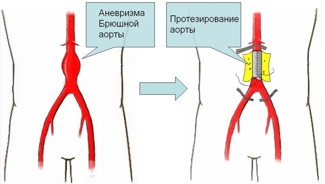 Лечение аневризмы брюшной аорты, операция аневризмы брюшной полости: цена в СПб.