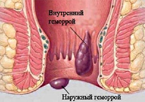 Острый геморрой: чем снять и как лечить