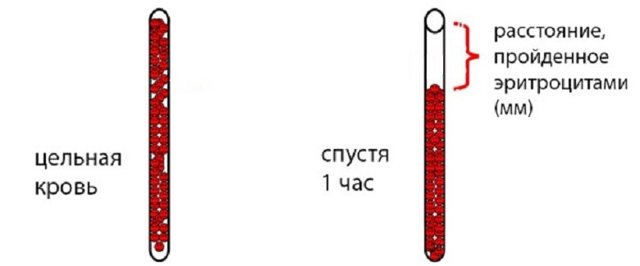 Норма и повышенный уровень роэ в крови у женщин
