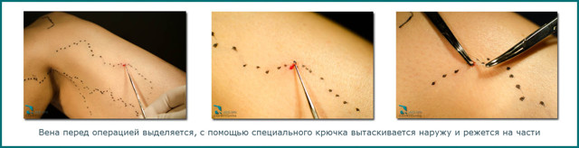 Что важно знать о флебэктомии — операции по удалению вен