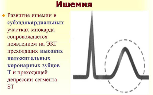 Признаки ишемии — E-Cardio