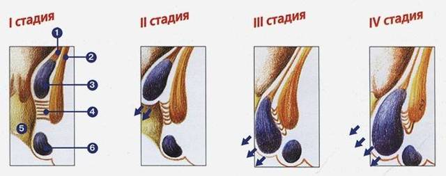 Что нужно делать если геморрой вылез наружу и болит