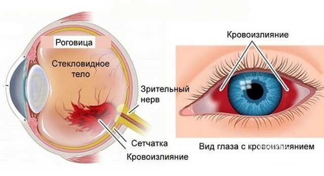 Кровоизлияние в глаз – причины, лечение, кровоизлияние после удара