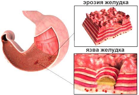 Гипертрофический гастрит - причины, симптомы и лечение