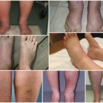 Отеки при варикозе - снимаем быстро и надолго