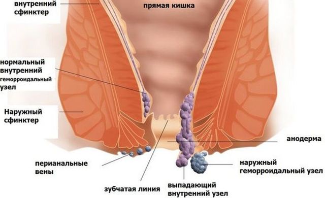 Геморрой у женщин: причины, признаки (фото), симптомы и лечение