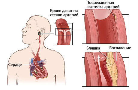 Пластырь от гипертонии: поможет ли трансдермальный китайский пластырь от давления hypertension patch - Здоровье и Кровь
