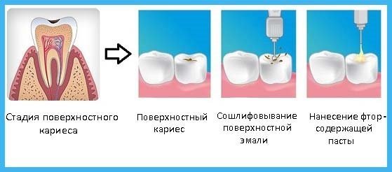 Поверхностный кариес - причины, симптомы и лечение