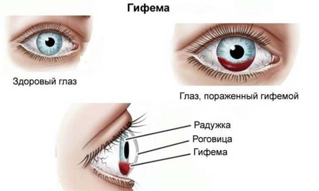 Кровоизлияние в глаз: лечение и причины