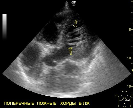 Ложная хорда левого желудочка - причины и лечение