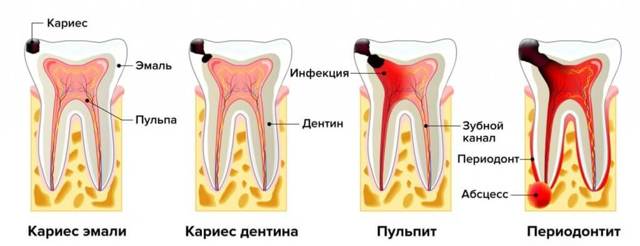Хронический периодонтит - причины, симптомы, диагностика и лечение