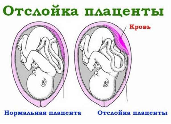 Беременность и группа крови