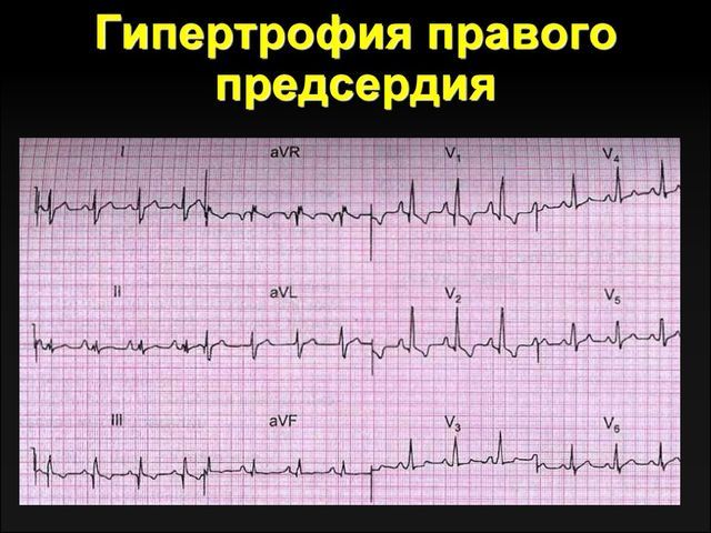Перегрузка правого предсердия причины - Все про гипертонию