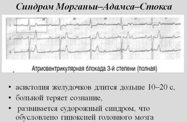 Блокада левой ножки пучка Гиса на ЭКГ (полная и неполная)