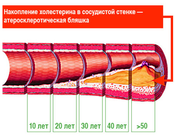 Сестринский процесс при стенокардии (ИБС)