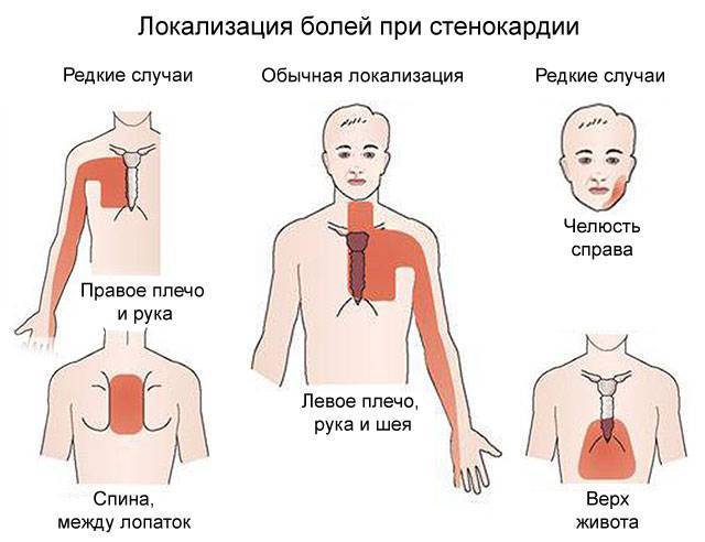 Атеросклероз аорты и алкоголь