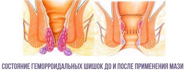 Мазь Левомеколь при геморрое - инструкция