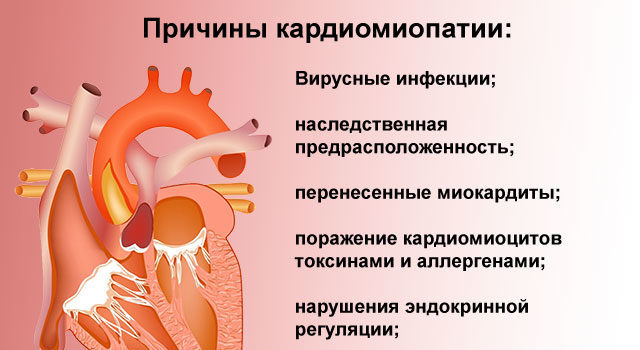 Кардиомиопатия сердца: симптомы и лечение