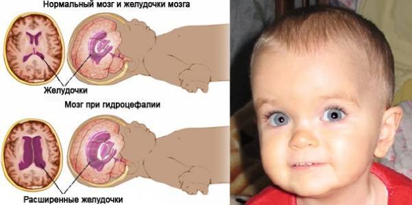 Гипертензионный синдром у детей и взрослых: симптомы, лечение