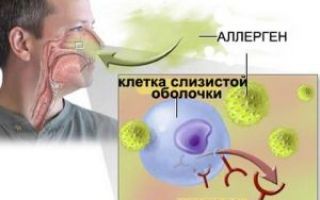 Синусопатия головного мозга