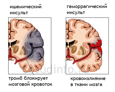 РЭГ (реоэнцефалография) сосудов головного мозга: что это такое и что показывает, методика обследования, расшифровка