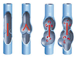 Варикозное расширение вен чем опасно на сайте варикоз