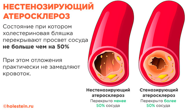 Нестенозирующий атеросклероз артерий