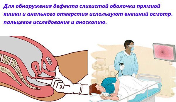 Лечение трещины заднего прохода без операции