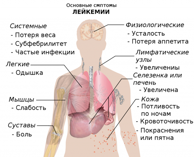 Лейкоз у детей – симптомы