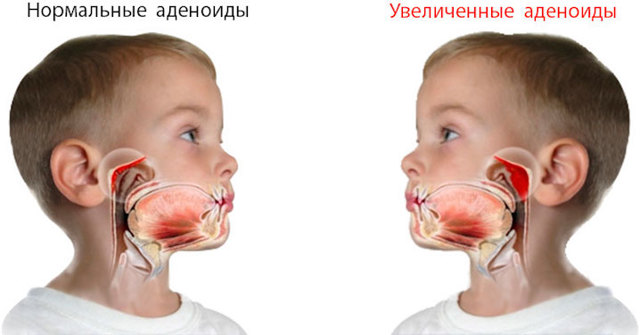 Аденоиды у детей клинические симптомы и лечение