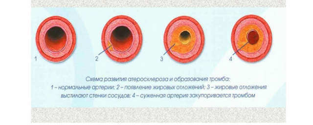 Гипоксия сердца симптомы и лечение