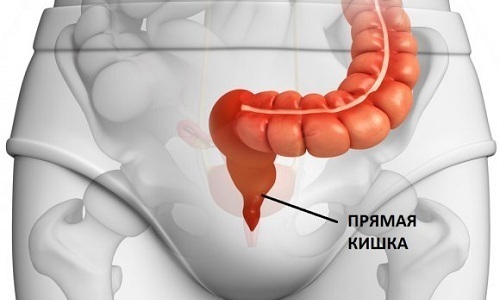 Геморройная шишка как лечить образование?