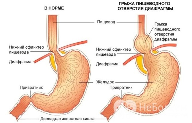 Грыжа пищевода – симптомы, лечение и диета
