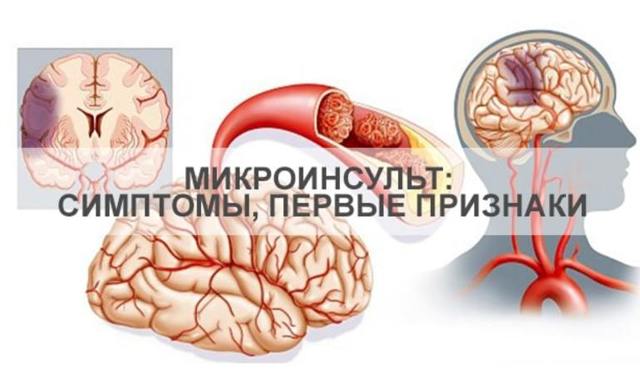 Микроинсульт – симптомы и последствия, признаки, лечение, или Берегите здоровье смолоду