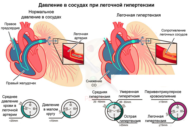 Что такое легочная гипертензия, её симптомы и лечение