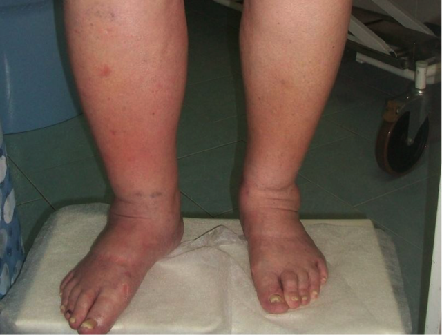 Отеки при варикозе - снимаем быстро и надолго