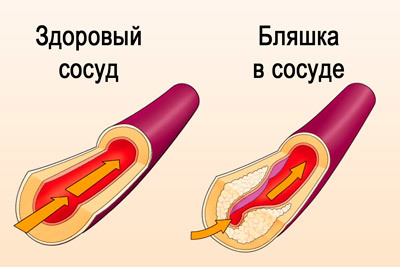 Крупноочаговый инфаркт миокарда