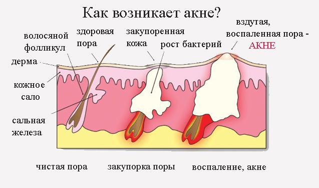 Прыщи (акне) у человека – причины и лечение