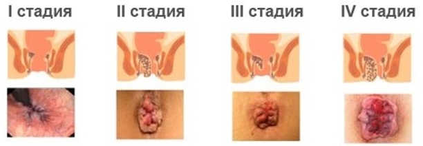 Почему при беременности появляется геморрой? Как лечить геморрой беременным женщинам?