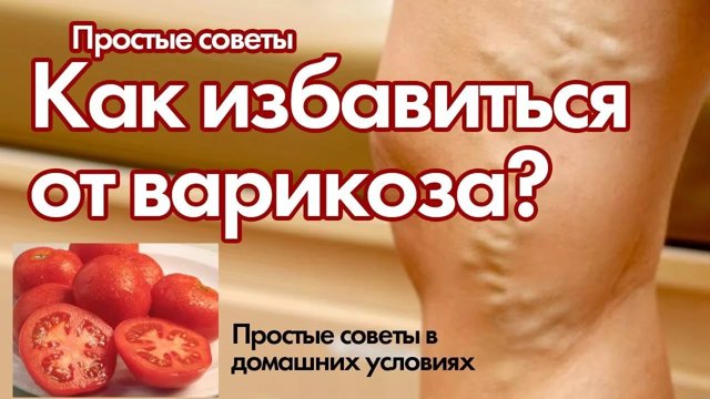 Народные средства от варикоза