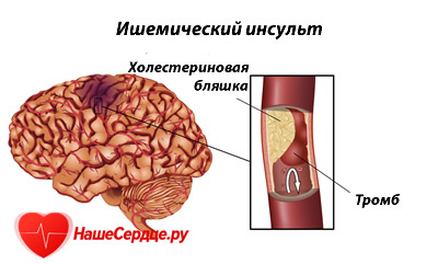 Ишемический инсульт: симптомы и лечение