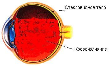 Кровь в глазном яблоке - Лечение глаз