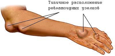 Ревматизм - причины, признаки, симптомы и лечение