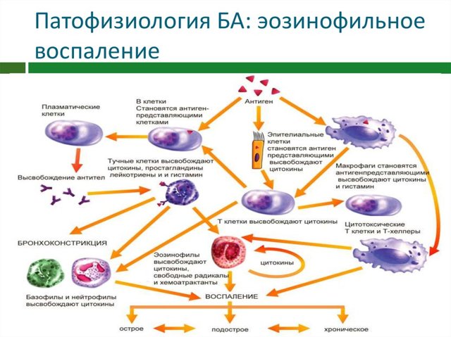 Эозинофилы при астме. Эозинофилия