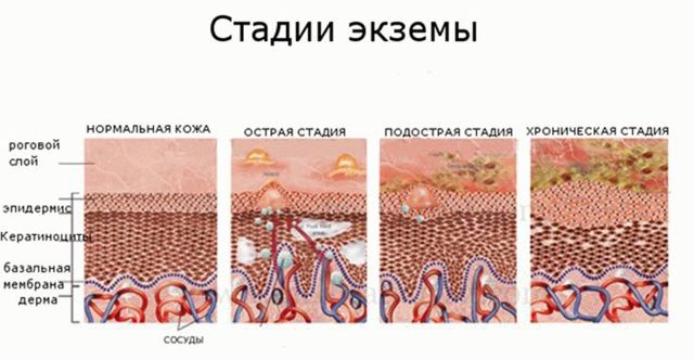 Мазь Флуцинар от чего помогает, показания к применению
