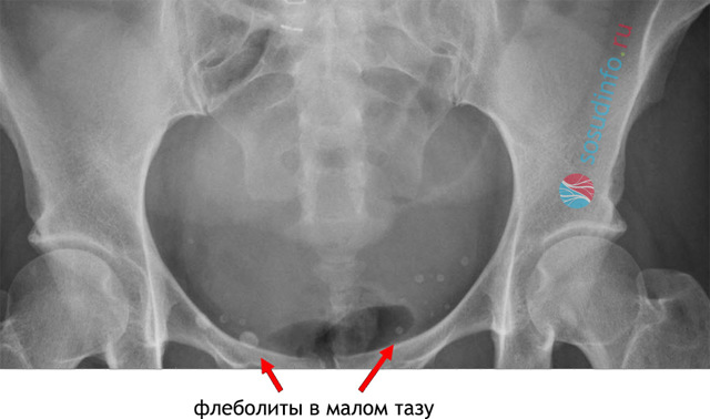Флеболиты в малом тазу у мужчин - Все про холестерин