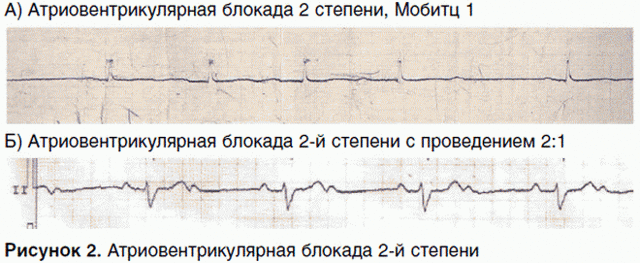 Блокада сердца 2 степени лечение